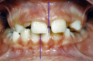 Σταυροειδής σύγκλειση - Ορθοδοντικός Δρ. Ζαρμπή