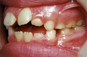 Διακοπή προώθησης γλώσσας - Ορθοδοντικός Δρ. Ζαρμπή