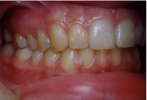 Στένωση, ασσυμετρία, συνωστισμός - Ορθοδοντικός Δρ. Ζαρμπή