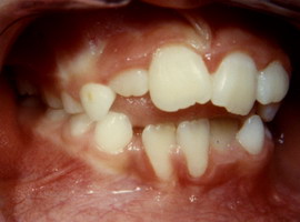 Έντονοι συνωστισμοί και οπισθογναθισμός κάτω γνάθου - Ορθοδοντικός Δρ. Ζαρμπή