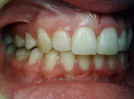 Έντονοι συνωστισμοί και οπισθογναθισμός κάτω γνάθου - Ορθοδοντικός Δρ. Ζαρμπή