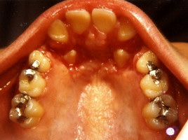 Έγκλειστοι κυνόδοντες - Ορθοδοντικός Δρ. Ζαρμπή