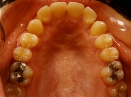 Έγκλειστοι κυνόδοντες - Ορθοδοντικός Δρ. Ζαρμπή