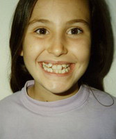 Συνωστισμός και υπερκάλυψη των κάτω δοντιών - Θεραπεία εξαγωγών