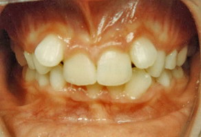 Συνωστισμός και υπερκάλυψη των κάτω δοντιών - Θεραπεία εξαγωγών