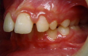 Στένωση άνω γνάθου, υπερκάλυψη κάτω δοντιών, οπισθογναθισμός της κάτω γνάθου