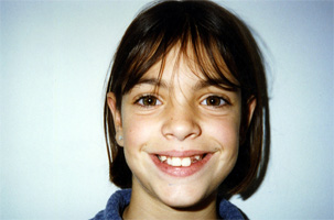 Έντονος συνωστισμός στην άνω και κάτω γνάθο. Θεραπεία χωρίς εξαγωγές