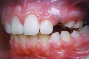 Διακοπή προώθησης γλώσσας - Ορθοδοντικός Δρ. Ζαρμπή