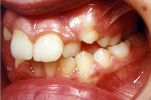 Έντονος συνωστισμός στην άνω και κάτω γνάθο. Θεραπεία χωρίς εξαγωγές