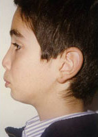 Έντονος συνωστισμός και υπερκάλυψη των κατω δοντιών. Θεραπεία χωρίς εξαγωγές