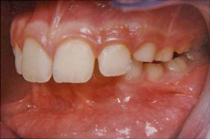 Έντονος συνωστισμός και υπερκάλυψη των κατω δοντιών. Θεραπεία χωρίς εξαγωγές