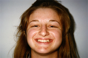 Συνωστισμος στην άνω και κάτω γνάθο και στένωση στην επάνω γνάθο. Θεραπεία εξαγωγών