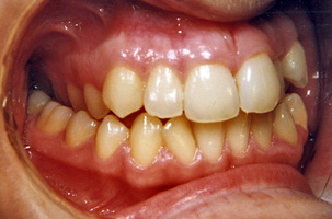 Συνωστισμος στην άνω και κάτω γνάθο και στένωση στην επάνω γνάθο. Θεραπεία εξαγωγών