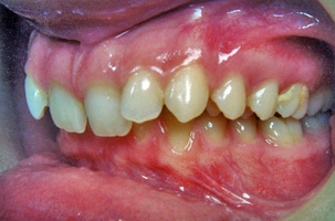 Συνωστισμός, υπερκάλυψη κάτω δοντιών και έγκλειστος κυνόδοντας στον ουρανίσκο. Θεραπεία εξαγωγών