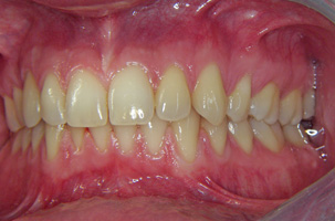 Συνωστισμός, υπερκάλυψη κάτω δοντιών και έγκλειστος κυνόδοντας στον ουρανίσκο. Θεραπεία εξαγωγών