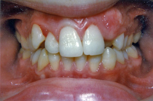 Συνωστισμοί, ασυμετρία, έγκλειστος κυνόδοντας στην άνω γνάθο