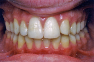 Συνωστισμοί, ασυμετρία, έγκλειστος κυνόδοντας στην άνω γνάθο