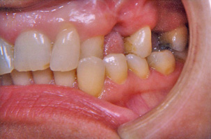 Ορθοδοντικά προβλήματα και απώλεις δοντιων. Ορθοδοντική - προσθετική θεραπεία