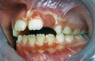 Διόρθωση στένωσης άνω γνάθου - Ορθοδοντικός Δρ. Ζαρμπή