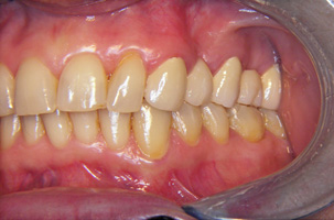 Ορθοδοντικά προβλήματα και απώλεις δοντιων. Ορθοδοντική - προσθετική θεραπεία