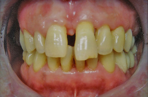 Περιοδοντική νόσος με μετακινήσεις δοντιών. Περιοδοντική-Ορθοδοντική-Προσθετική θεραπεία