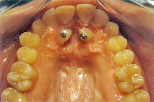 Υπερκάλυψη των κάτω προσθίων δοντιών