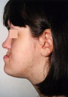 Βαρύτατος προγναθισμός της κάτω γνάθου με υποπλασία της άνω γνάθου