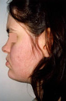 Βαρύτατος προγναθισμός της κάτω γνάθου με υποπλασία της άνω γνάθου