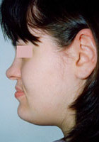 Βαρύτατος προγναθισμός της κάτω γνάθου με υποπλασία της άνω γνάθου