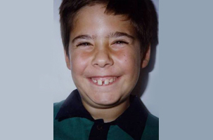 Στένωση, υπερκάλυψη κάτω δοντιών, έντονος οπισθογναθισμός, διάστημα προσθίων δοντιών