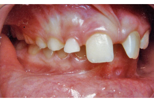 Στένωση, υπερκάλυψη κάτω δοντιών, έντονος οπισθογναθισμός, διάστημα προσθίων δοντιών