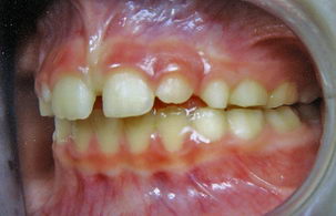 Διόρθωση στένωσης άνω γνάθου - Ορθοδοντικός Δρ. Ζαρμπή