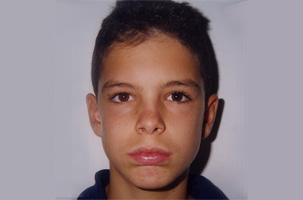 Συνωστισμός στην άνω και κάτω γνάθο και στένωση στην επάνω γνάθο. Θεραπεία εξαγωγών