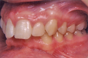 Συνωστισμός στην άνω και κάτω γνάθο και στένωση στην επάνω γνάθο. Θεραπεία εξαγωγών