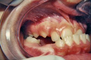 Έντονος προγναθισμός κάτω γνάθου - Ορθοδοντική Θεραπεία Δρ. Ζαρμπή