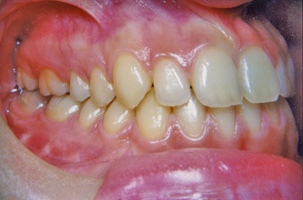 Έντονος προγναθισμός κάτω γνάθου - Ορθοδοντική Θεραπεία Δρ. Ζαρμπή