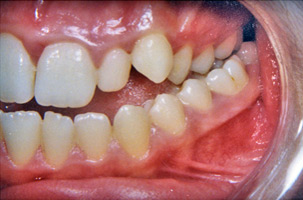 Στένωση και συνωστισμός στην άνω γνάθο