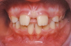 Διάστημα μεταξύ των επάνω δοντιών - Ορθοδοντικός Δρ. Ζαρμπή