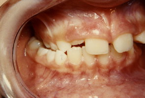 Στένωση, ασσυμετρία, συνωστισμός - Ορθοδοντικός Δρ. Ζαρμπή