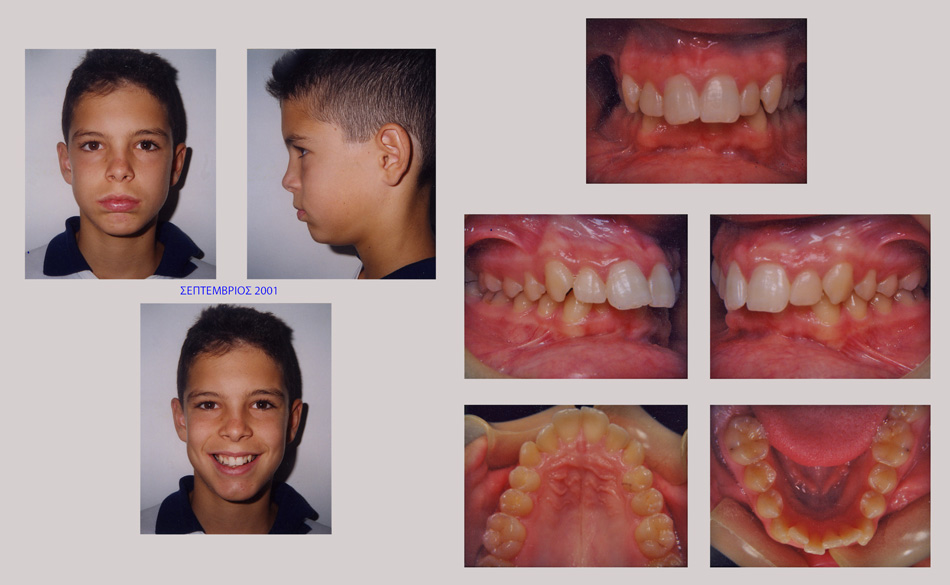 Συνωστισμός στην άνω και κάτω γνάθο και στένωση στην επάνω γνάθο. Θεραπεία εξαγωγών