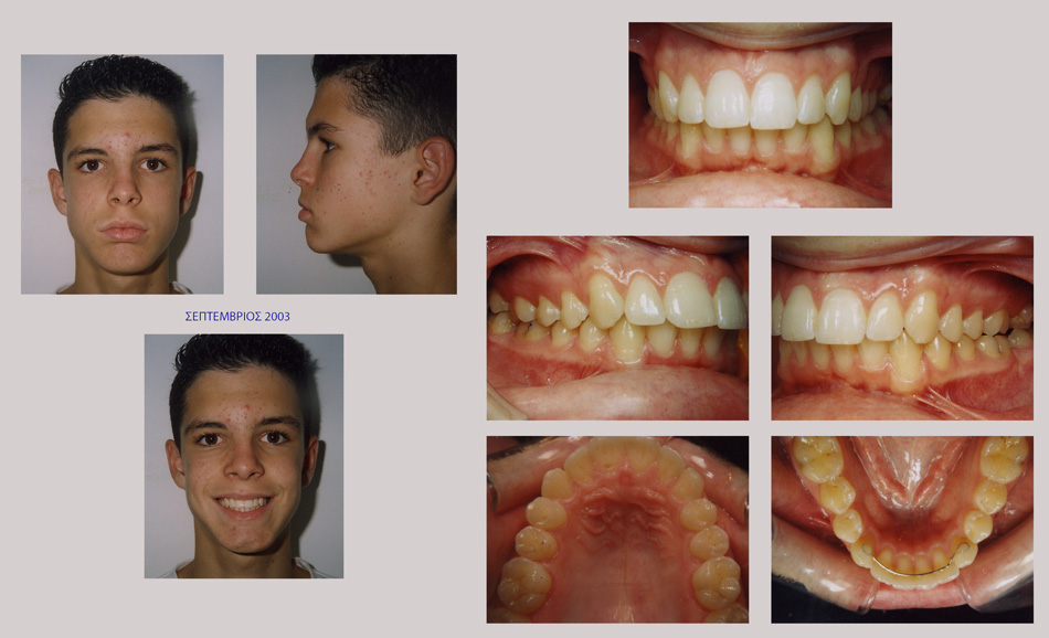 Συνωστισμός στην άνω και κάτω γνάθο και στένωση στην επάνω γνάθο. Θεραπεία εξαγωγών