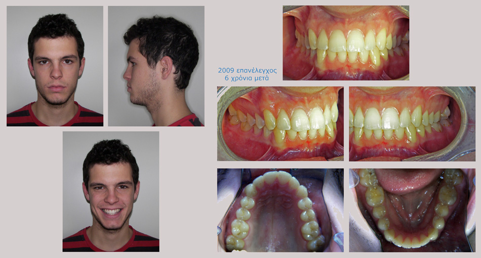 Συνωστισμός στην άνω και κάτω γνάθο και στένωση στην επάνω γνάθο. Θεραπεία εξαγωγών