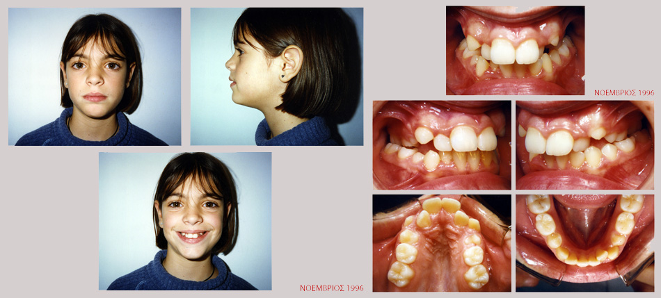 Έντονος συνωστισμός στην άνω και κάτω γνάθο. Θεραπεία χωρίς εξαγωγές