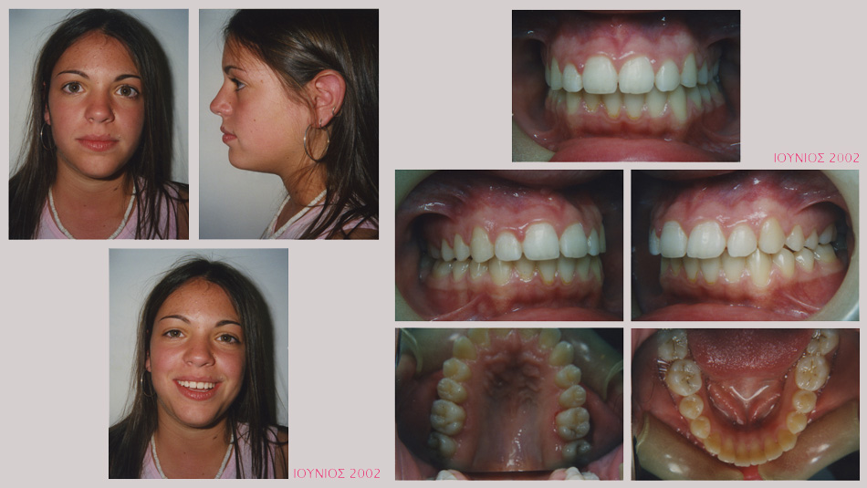 Έντονος συνωστισμός στην άνω και κάτω γνάθο. Θεραπεία χωρίς εξαγωγές