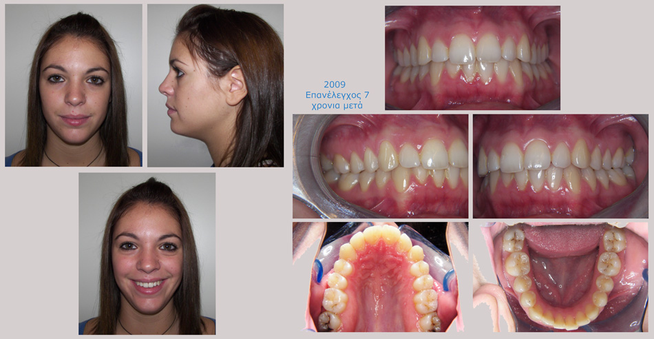 Έντονος συνωστισμός στην άνω και κάτω γνάθο. Θεραπεία χωρίς εξαγωγές