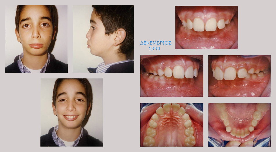 Έντονος συνωστισμός και υπερκάλυψη των κατω δοντιών. Θεραπεία χωρίς εξαγωγές