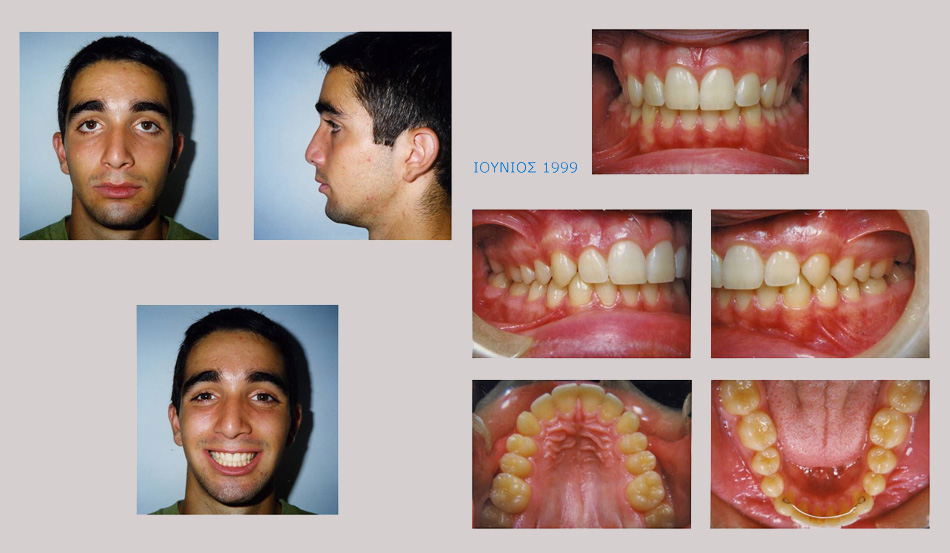 Έντονος συνωστισμός και υπερκάλυψη των κατω δοντιών. Θεραπεία χωρίς εξαγωγές