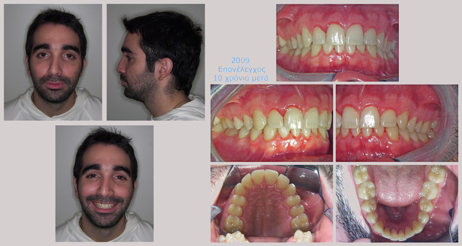 Έντονος συνωστισμός και υπερκάλυψη των κατω δοντιών. Θεραπεία χωρίς εξαγωγές