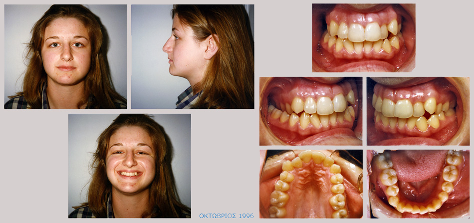 Συνωστισμος στην άνω και κάτω γνάθο και στένωση στην επάνω γνάθο. Θεραπεία εξαγωγών