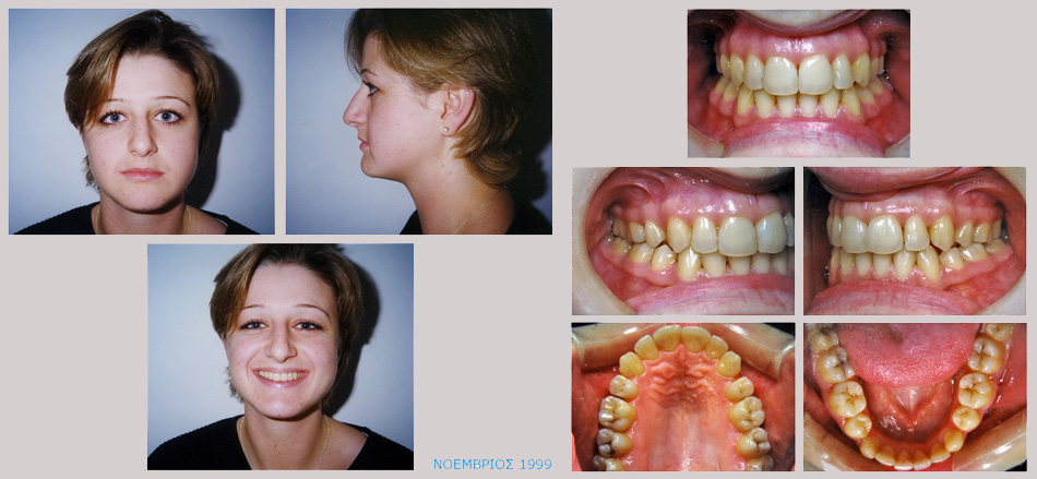 Συνωστισμος στην άνω και κάτω γνάθο και στένωση στην επάνω γνάθο. Θεραπεία εξαγωγών